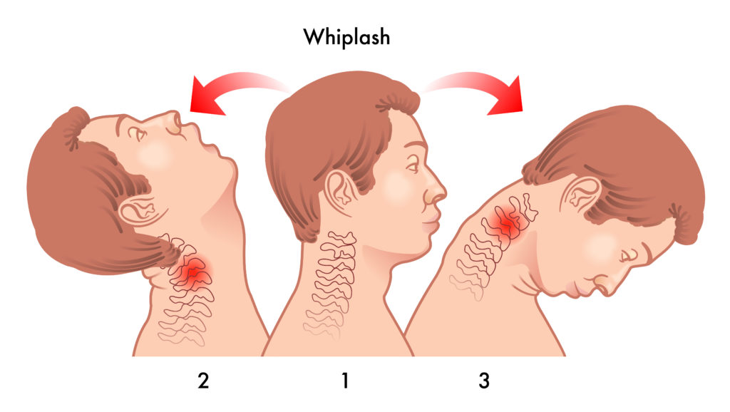 Whiplash Is Caused By The Neck Moving Back And Forth At A High Rate Of Speed.