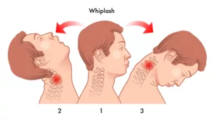 Diagram An Arlington Whiplash Injury Lawyer Would Use In Court