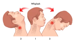 Whiplash Neck Injury Diagram