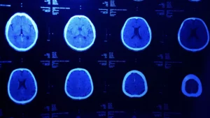 A Series Of Brain Scan Images Displayed On A Screen, Highlighting The Potential Severity Of Traumatic Brain Injuries And The Need For An Experienced Arlington Catastrophic Injury Lawyer To Advocate For Victims Facing Life-Altering Conditions.