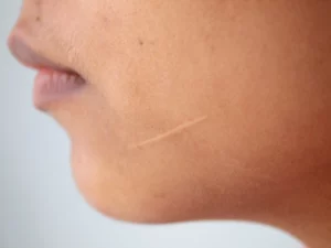 Scar On A Face Is Considered Disfigurement