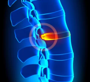 Illustration Of A Spinal Disc Injury Used To Visually Address The Question: Can A Car Accident Cause A Bulging Disc?